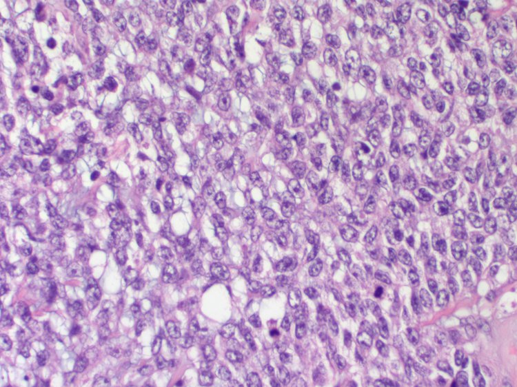 cystic breast carcinoma Cystic breast carcinoma