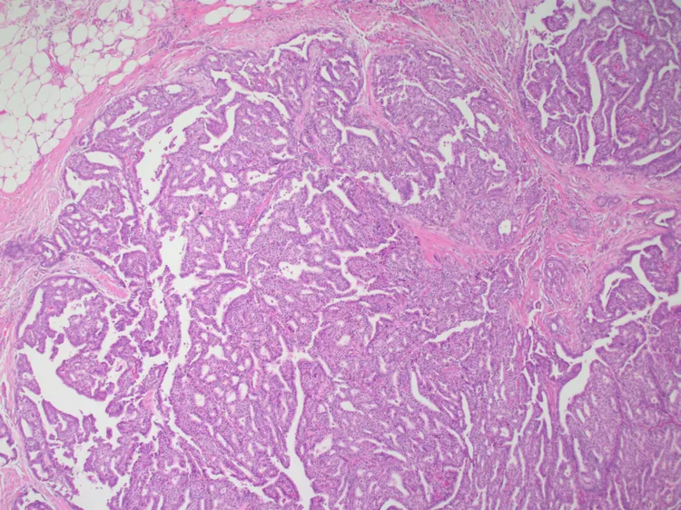 Invasive Papillary Carcinoma Of Breast Dovemed 0680