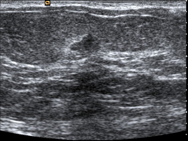 Ultrasound-Guided Biopsy of Breast - DoveMed