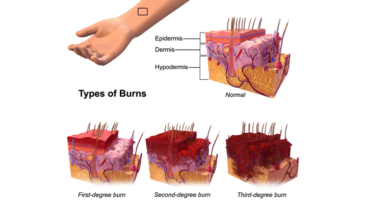 1st degree burn treatment for baby