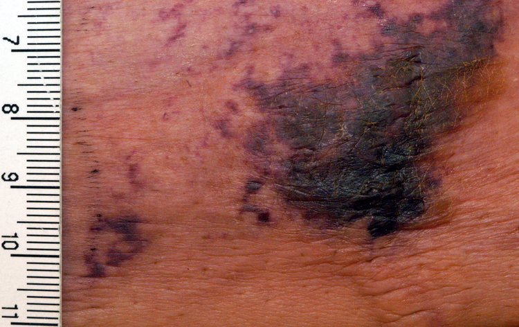 Calciphylaxis calciphylaxis
