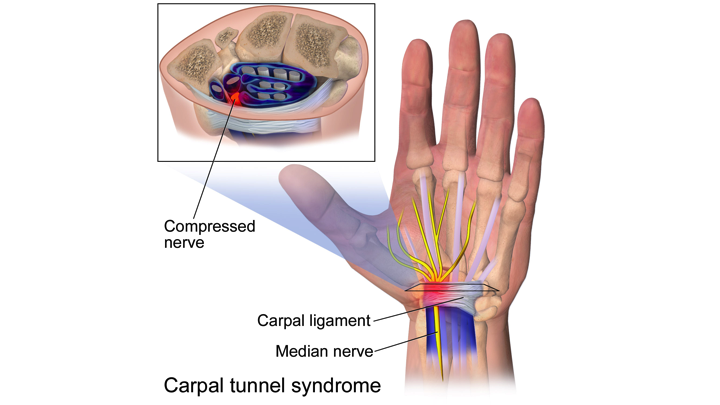 carpal-tunnel-syndrome-cts