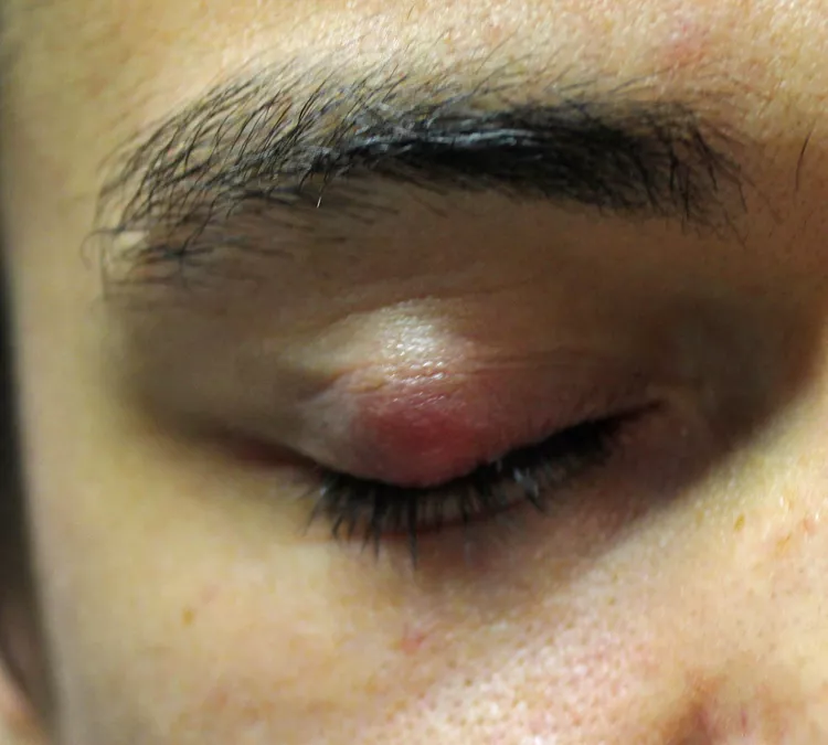 Facts about Chalazion - DoveMed