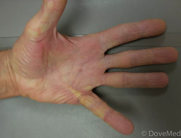 Dupuytren’s Contracture - DoveMed