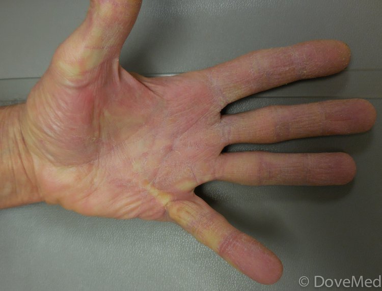 Dupuytrens Contracture