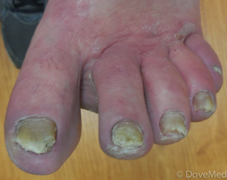 Fungal Infection Around Fingernails 