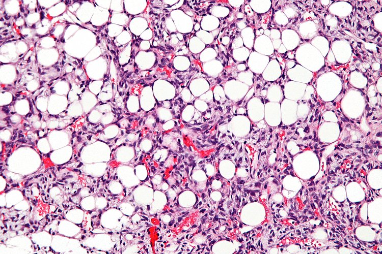 Dedifferentiated Liposarcoma