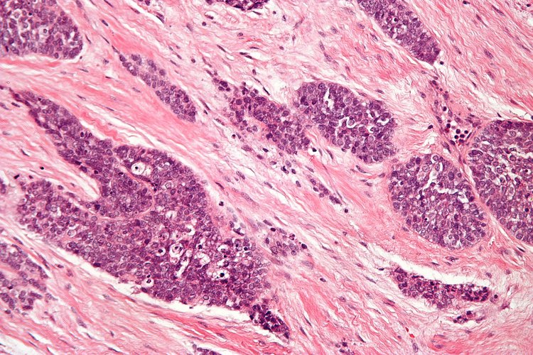 Desmoplastic Small Round Cell Tumor (DSRCT)