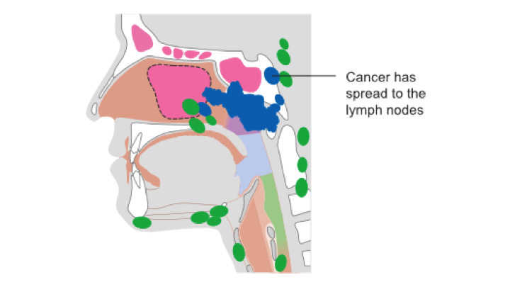 Nasopharyngeal cancer survivor: Why I got a cancer strikethrough