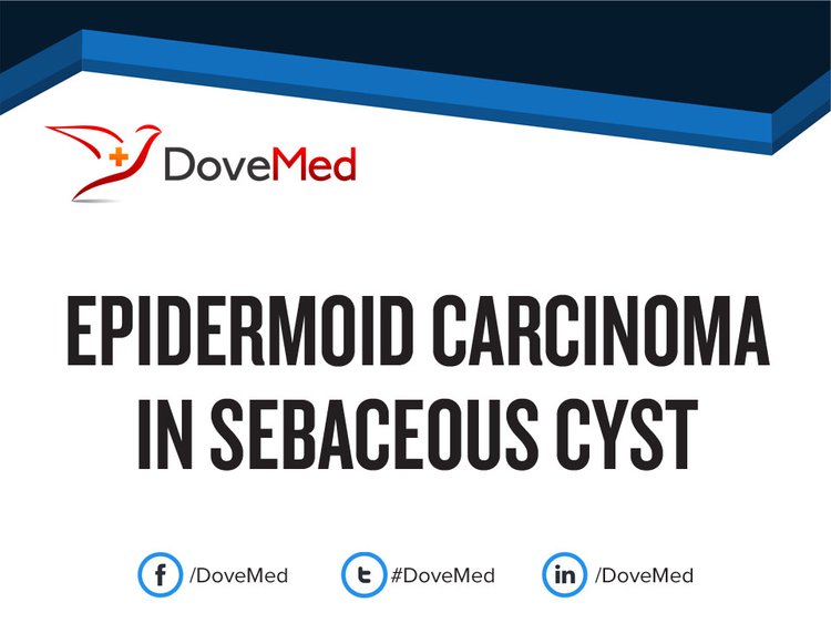 Epidermoid Carcinoma in Sebaceous Cyst