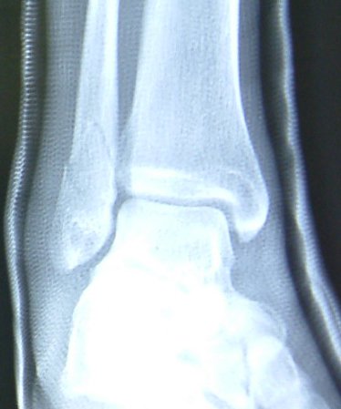 fractured fibula cast