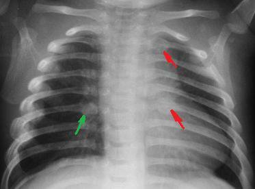 Fractured Rib DoveMed