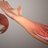 A 3D medical animation still shot illustrating the medical condition known as Golfer's elbow.