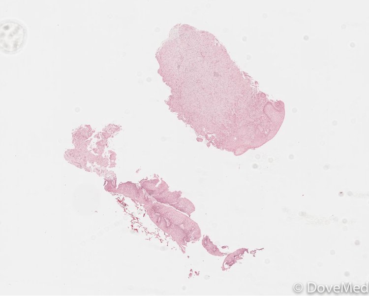 Granular Cell Tumor Of Esophagus