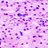 Microscopic pathology image showing Malignant Granular Cell Tumor of the Skin. H&E stain.