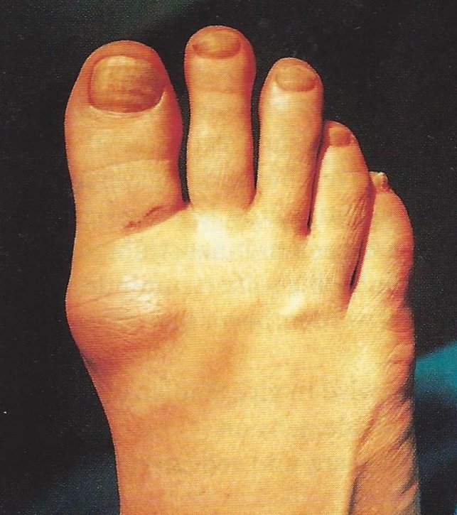 Facts about Hallux Rigidus.