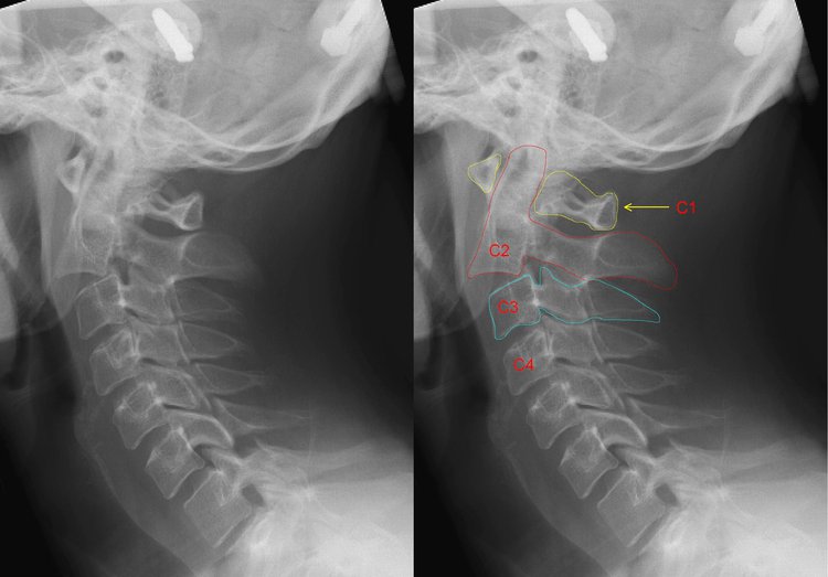 Cervical Fracture rib  damage diagram 