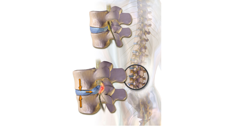 Herniated Disc