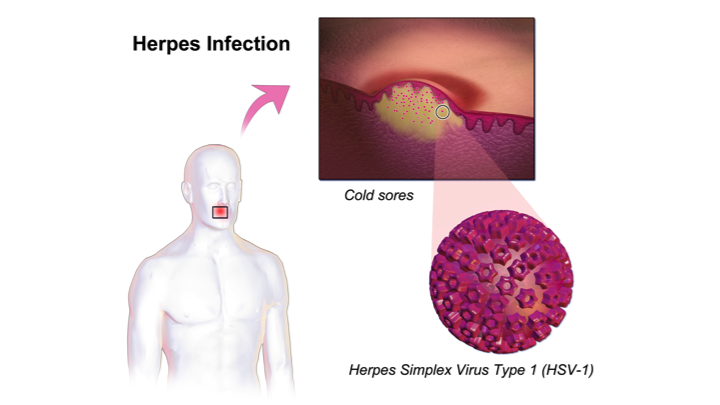 Herpes Infection 16x9.width 750 