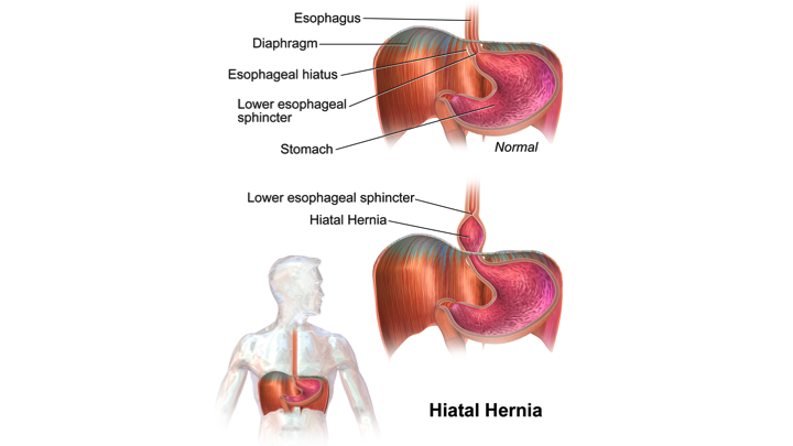 hourglass stomach sliding hernia