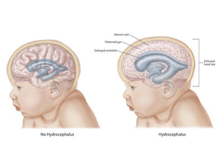 Congenital Hydrocephalus