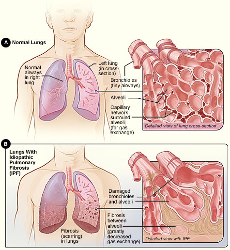 pulmonary-fibrosis