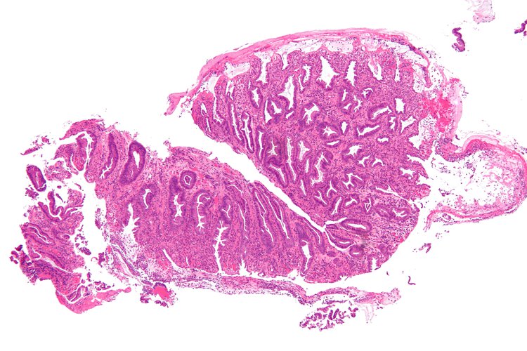 colitis-signature-health-services