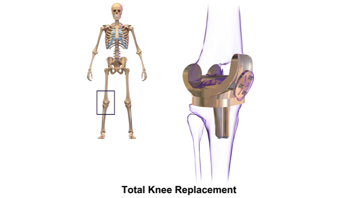 Total Knee Replacement