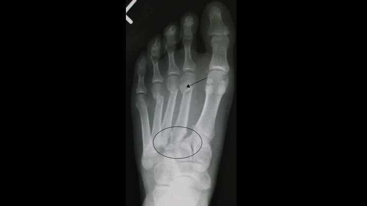 Lisfranc Fracture