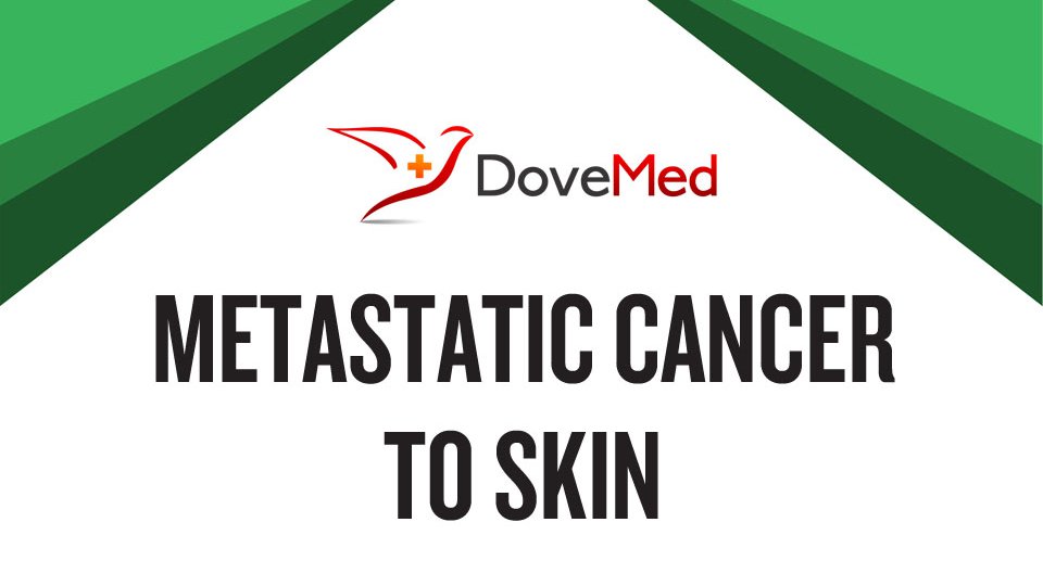 How Well Do You Know Metastatic Cancer To Skin