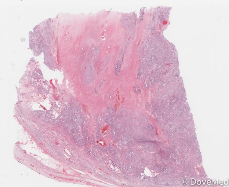 Mixed Germ Cell Tumor of the Testis