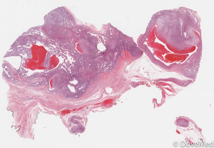 Myopericytoma of the Genitourinary System