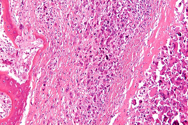 Osteosarcoma of Jaw Bones