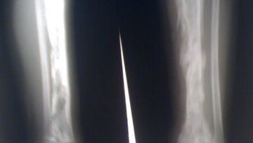 Ostermyelitis Tibia