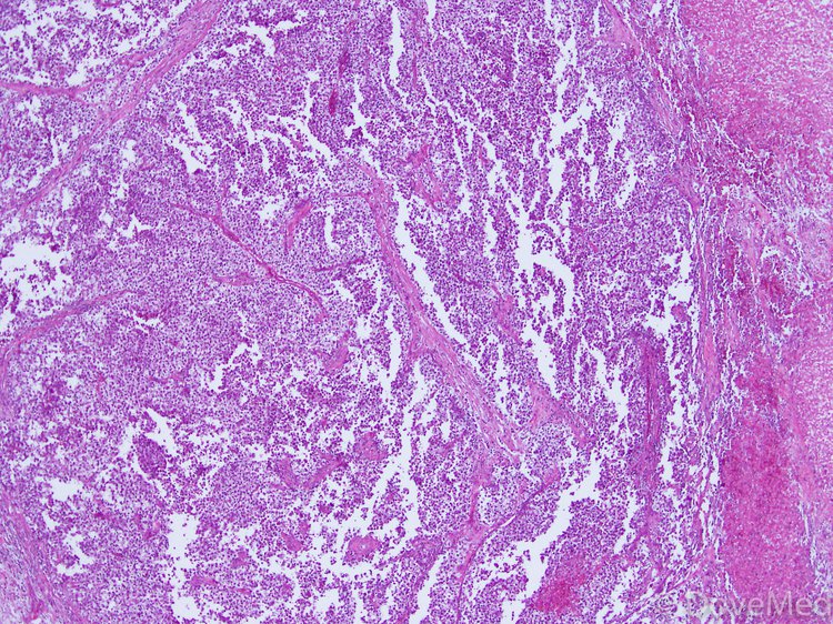 Seminoma of Testis