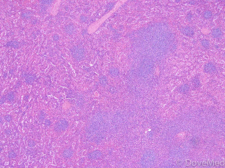 Lymphoma of Testis - DoveMed