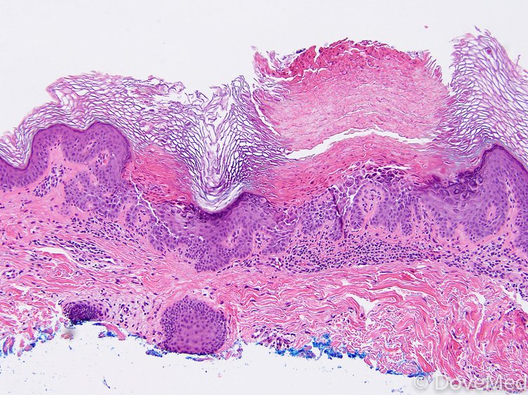 Transient Acantholytic Dermatosis