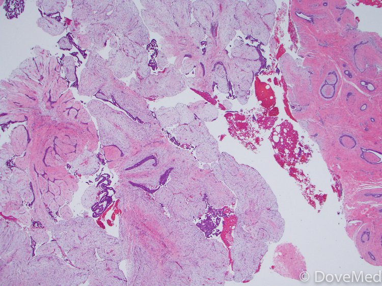 Types Of Benign Breast Lumps