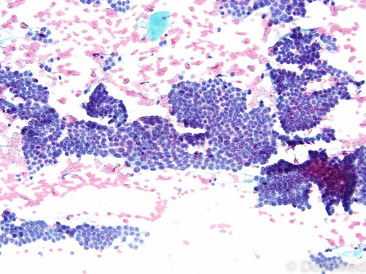 Papillary Thyroid Cancer