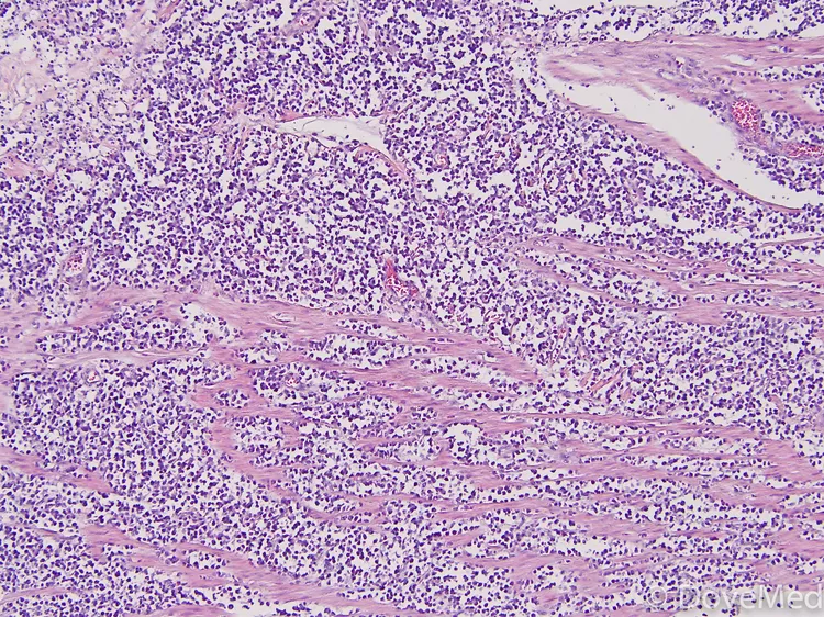 Burkitt Lymphoma of Small Intestine - DoveMed