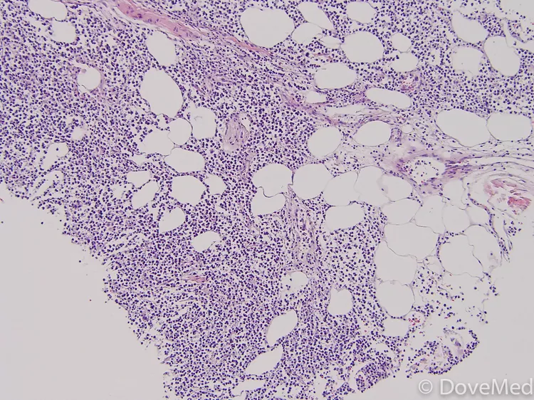 Burkitt Lymphoma of Breast - DoveMed