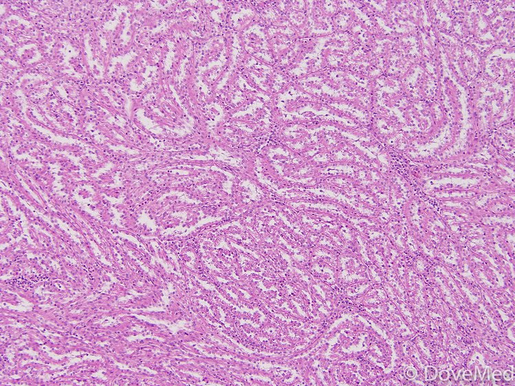 Mucinous Tubular and Spindle Cell Carcinoma of Kidney