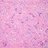 Microscopic pathology image showing high grade metaplastic carcinoma of breast showing infiltrating malignant glands in a dense osteoid like stroma.