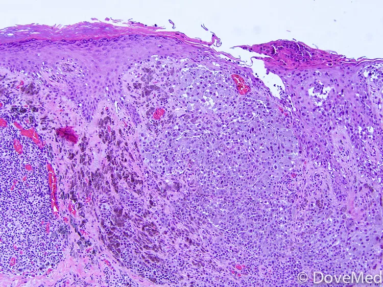 Amelanotic Melanoma - DoveMed