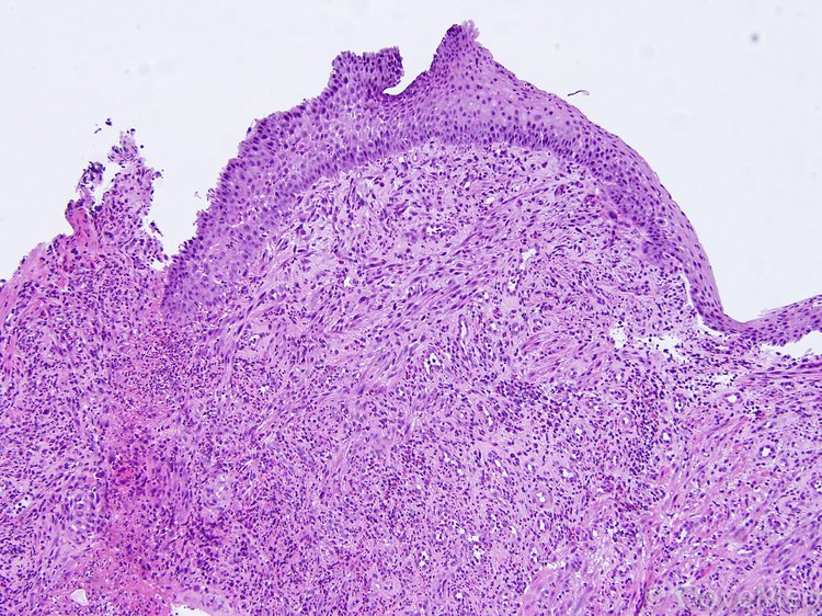 Pyogenic Granuloma 3374