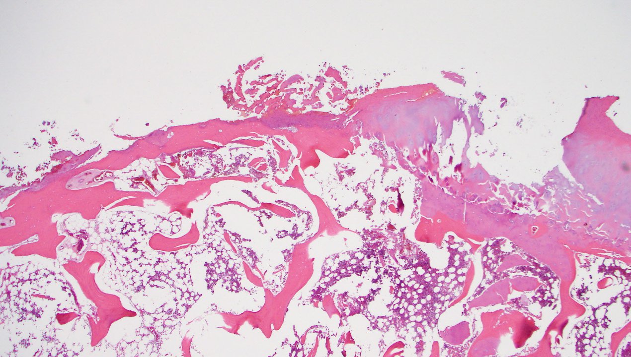 Acute Osteomyelitis