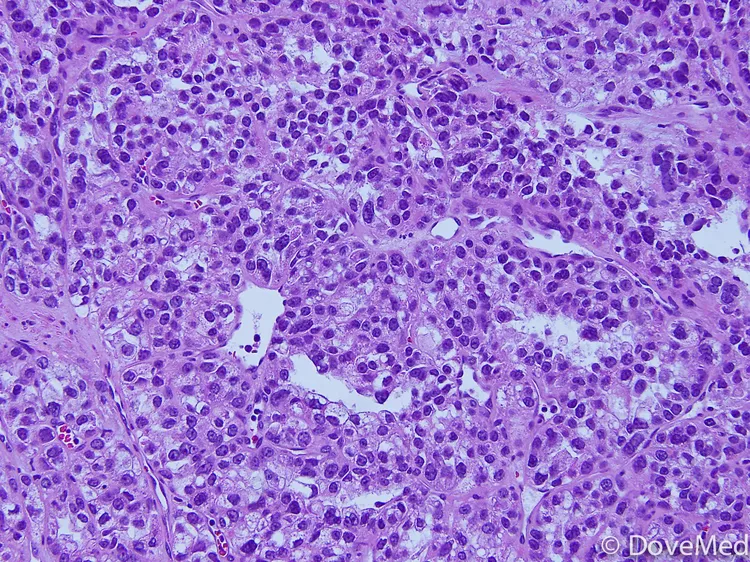 Clear Cell Carcinoma of Ampulla of Vater - DoveMed