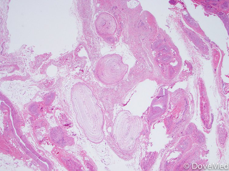 Arteriovenous Malformation Histology