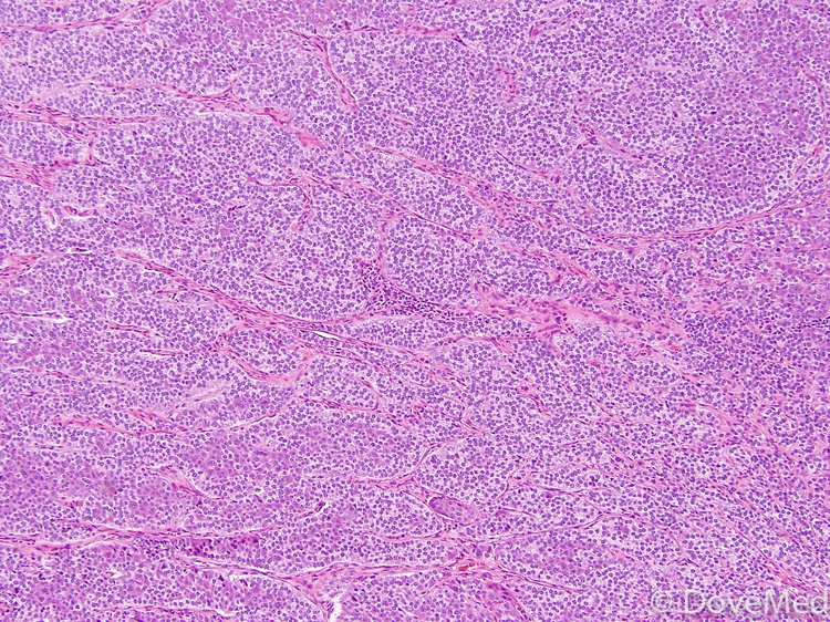 Subungual Glomus Tumor