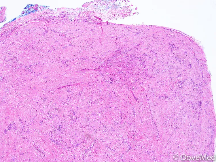 leiomyoma of colon icd 10